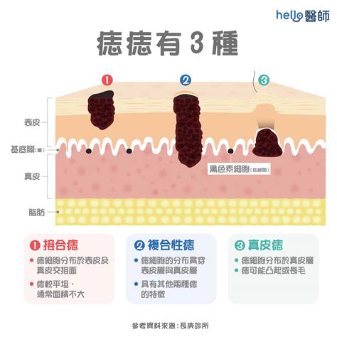 大痣|痣形成的原因？痣長毛、痣變多變大是痣病變？5招判。